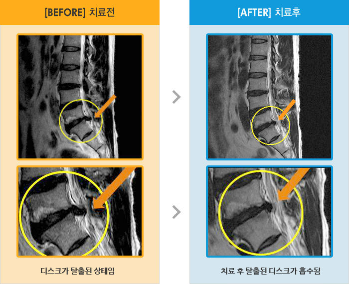 자생한방병원 치료사례 MRI로 보는 치료결과-왼쪽 다리뒤로 내려오는 통증과 저림
