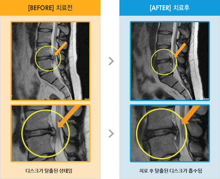 자생한방병원 치료사례 MRI로 보는 치료결과-왼쪽 다리 뒤부터 발끝까지 저림