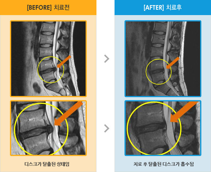 자생한방병원 치료사례 MRI로 보는 치료결과-허리 통증과 좌측 하지 신경 증상으로 내원