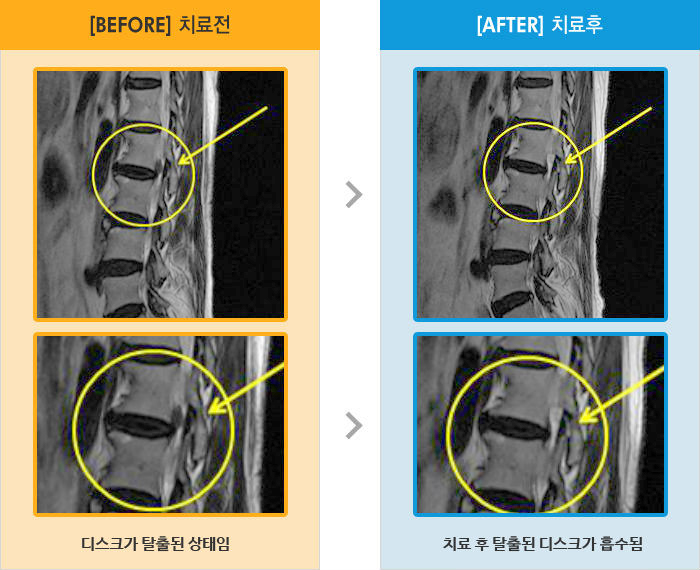 자생한방병원 치료사례 MRI로 보는 치료결과-허리 통증으로 보행, 거동 불편