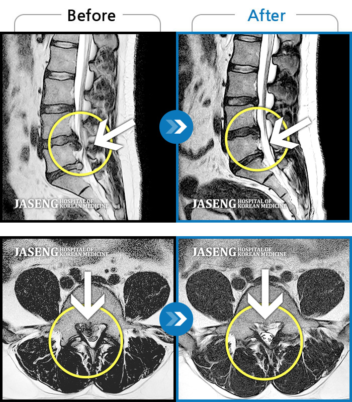 자생한방병원 치료사례 MRI로 보는 치료결과-우측 다리 통증이 심하고 발목 힘이 빠져요. 