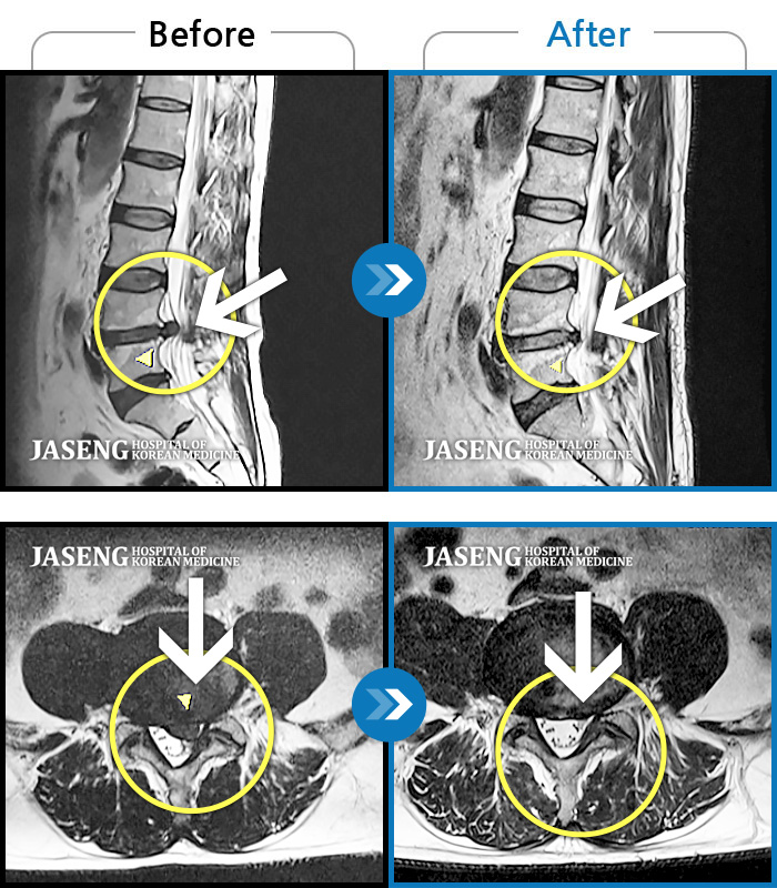 자생한방병원 치료사례 MRI로 보는 치료결과-좌측 허리 통증, 좌측 하지 뒤쪽으로 저림 증상