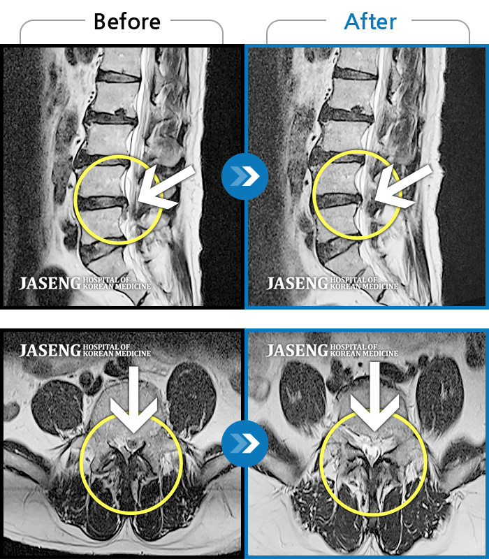 자생한방병원 치료사례 MRI로 보는 치료결과-앉아있다가 일어서면 왼쪽 다리와 발목이 당긴다.