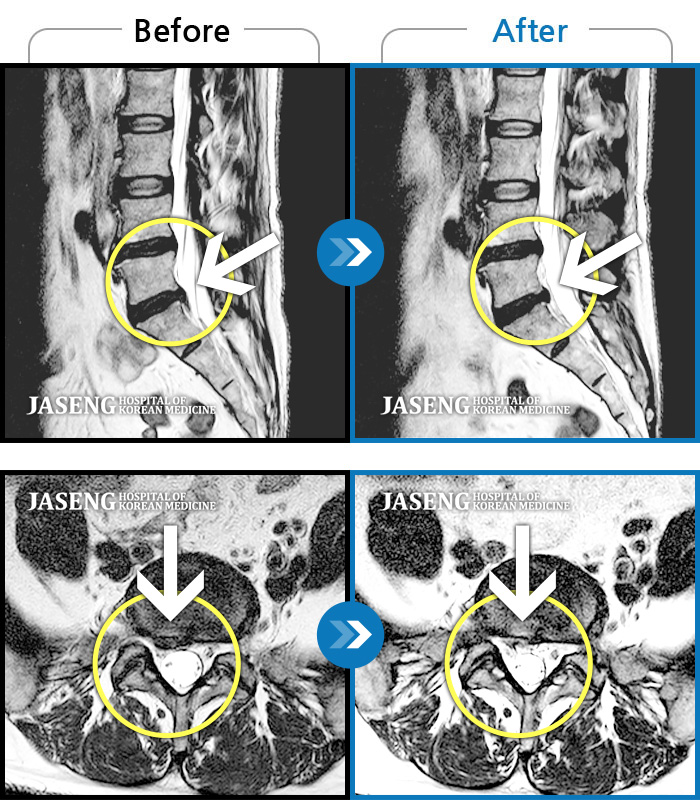 자생한방병원 치료사례 MRI로 보는 치료결과-허리와 우측 다리부터 발까지 당기는 통증이 심해요.
