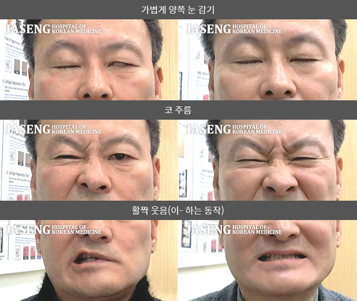 자생한방병원 치료사례 MRI로 보는 치료결과-좌측 눈이 안감기고 좌측으로 입이 마비되어 양치질 할 때 물이 새었다. 