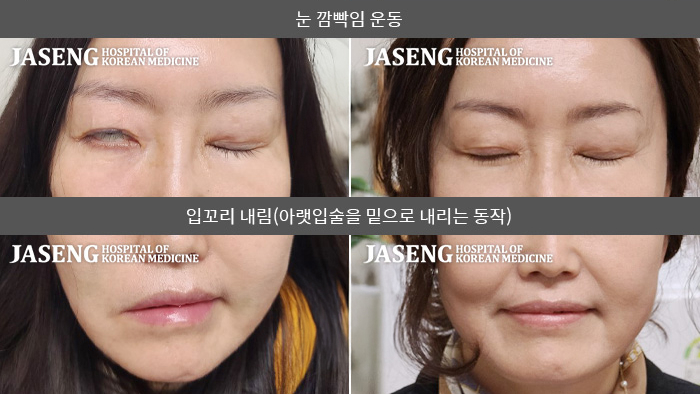 자생한방병원 치료사례 MRI로 보는 치료결과-우측 안면마비증상으로 우측 눈이 안감기고, 입꼬리가 좌측으로 올라가 있어 음식물도 씹기 힘든 상태였다.