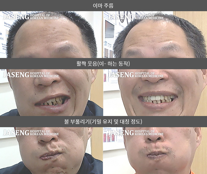 자생한방병원 치료사례 MRI로 보는 치료결과-우측 눈이 안감기고 이마주름이 안 잡히며 우측으로 입이 마비되어 양치 시 물이 새고 우측귀뒤 통증 목통증 있음