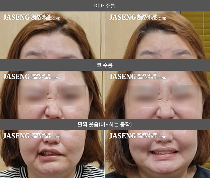 자생한방병원 치료사례 MRI로 보는 치료결과-좌측 안면부 감각저하, 좌측눈 닫히지 않아 시림. 발음 어눌하고 음수 시 물이 샘