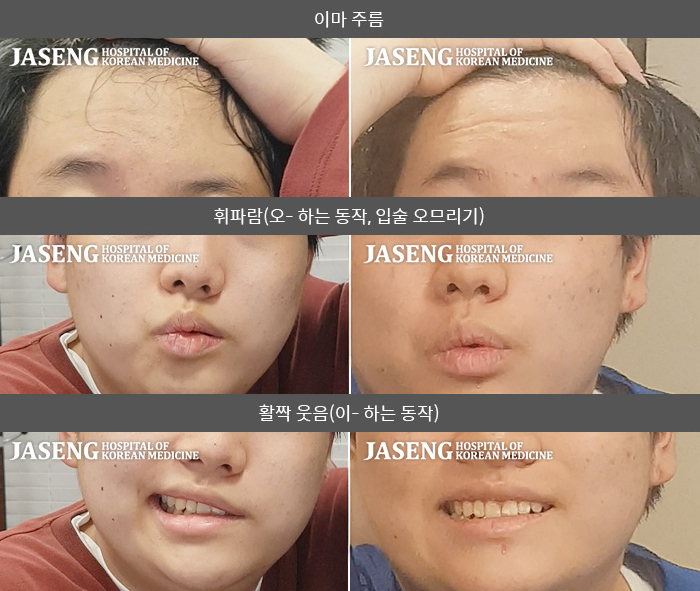 자생한방병원 치료사례 MRI로 보는 치료결과-왼쪽 눈이 잘 안 감기고 왼쪽 안면부 전체 마비된 느낌이다. 