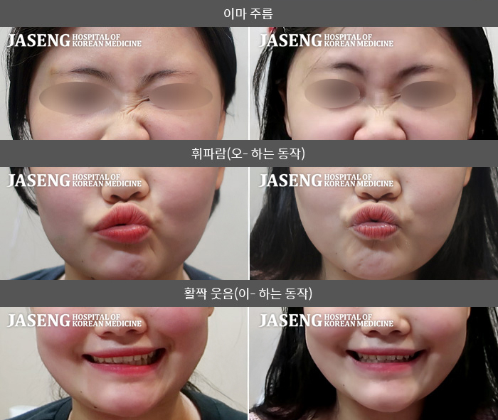 자생한방병원 치료사례 MRI로 보는 치료결과-에어컨 앞에서 일하다 갑자기 발생한 우측 안면마비 