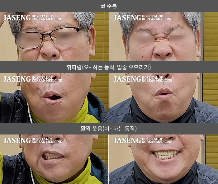 자생한방병원 치료사례 MRI로 보는 치료결과-좌측 안면마비