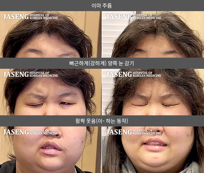 자생한방병원 치료사례 MRI로 보는 치료결과-왼쪽 눈이 잘 안 감기고 왼쪽 안면부 전체 마비된 느낌이다. 