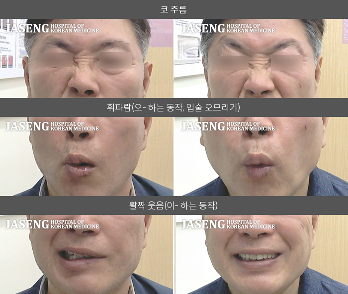 자생한방병원 치료사례 MRI로 보는 치료결과-샤워기로 안면 세안 중 물집이 터지면서 좌측안면마비가 발생함. 좌측 감각이 떨어짐 