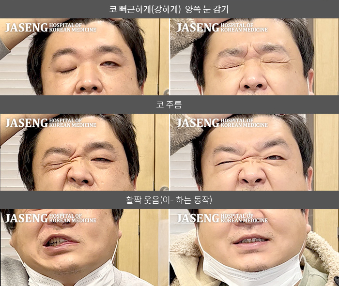 자생한방병원 치료사례 MRI로 보는 치료결과-좌측 눈 감기 힘들고, 입이 우측으로 치우치고 좌측 얼굴에 손대면 감각이 떨어진다.