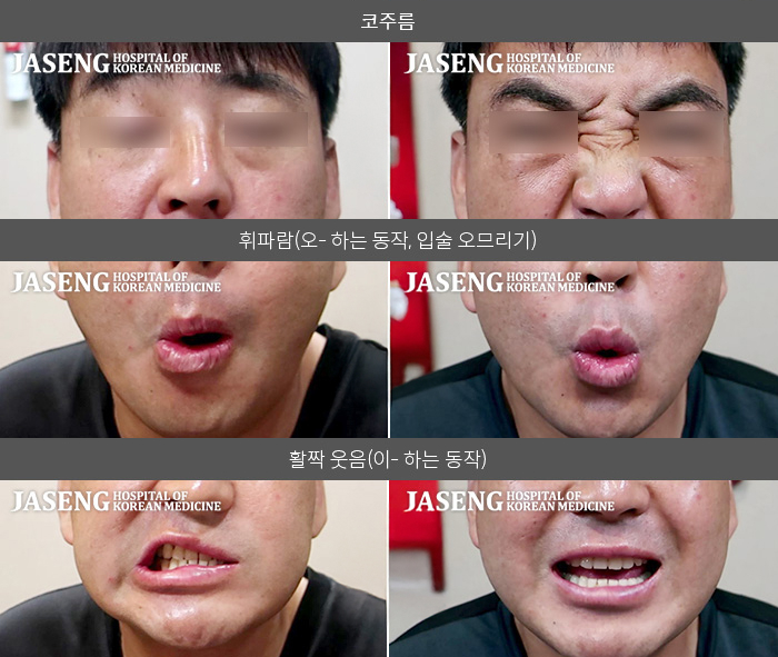 자생한방병원 치료사례 MRI로 보는 치료결과-치과치료 받다가 발생한 안면신경마비로 미각도 소실 되었다가 4주 만에 증상이 호전 