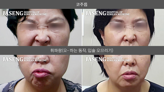 자생한방병원 치료사례 MRI로 보는 치료결과-반대쪽 얼굴에 두번째로 재발한 안면신경마비가 8주 만에 완치 