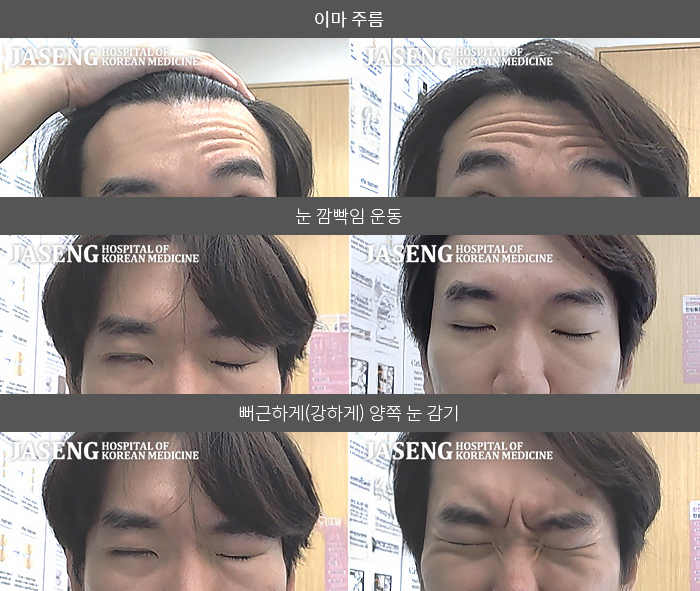 자생한방병원 치료사례 MRI로 보는 치료결과-안면마비 발생 전 우측으로 귀 뒤 통증이 발생하면서 우측 눈감기가 부자연스럽고 우측 입주위가 마비되어 불편함 