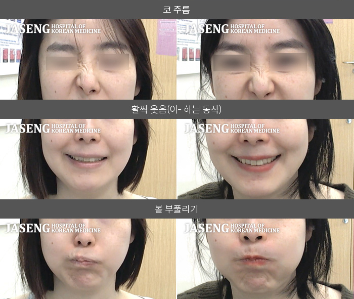 자생한방병원 치료사례 MRI로 보는 치료결과-좌측 눈이 감기지않고  속도가 느려지며  볼부위 마비로  좌측 입 감각 이상 및 우측이 편위 되어 불편함  