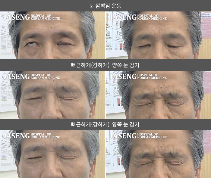 자생한방병원 치료사례 MRI로 보는 치료결과-중국 주재원근무중 안면마비 발생 초기, 중국에서 치료 후 내원