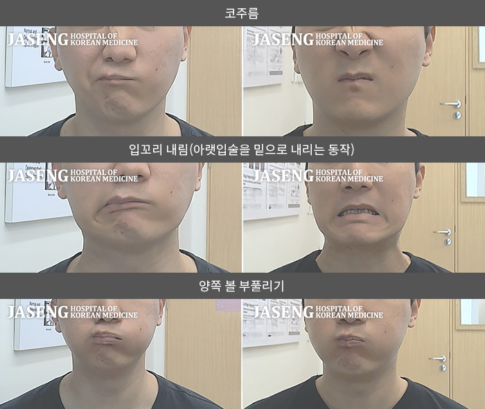 자생한방병원 치료사례 MRI로 보는 치료결과-과도한 공부 및 스트레스로 좌측 안면마비 발생 