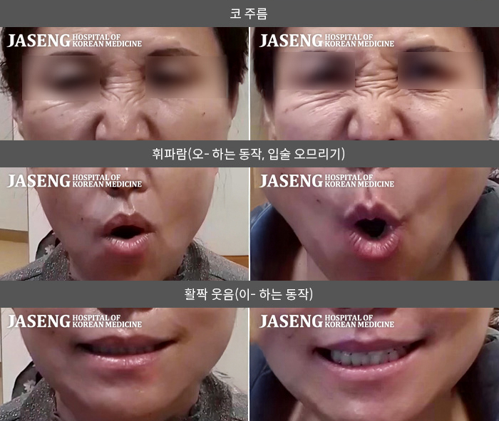 자생한방병원 치료사례 MRI로 보는 치료결과-우측 윗입술이 반대쪽으로 쏠리는 느낌이 들고 우측 혀의 감각이 없어요.