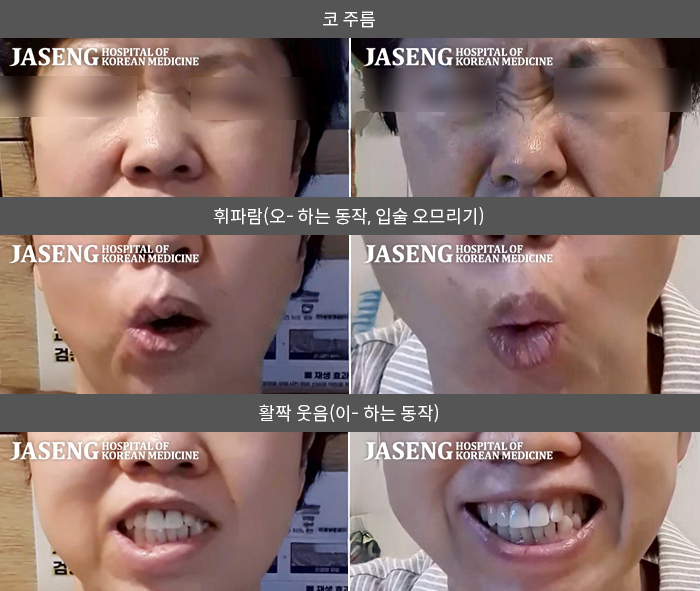 자생한방병원 치료사례 MRI로 보는 치료결과-좌측 눈 밑이 떨리는 느낌이 있어요. 