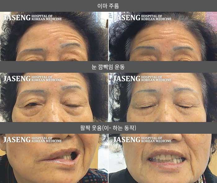 자생한방병원 치료사례 MRI로 보는 치료결과-별무이유 없이 발생. 타한의원 치료 한약치료 시행후 호전미약해 10/9 발병, 5일후 본원 처음내원  