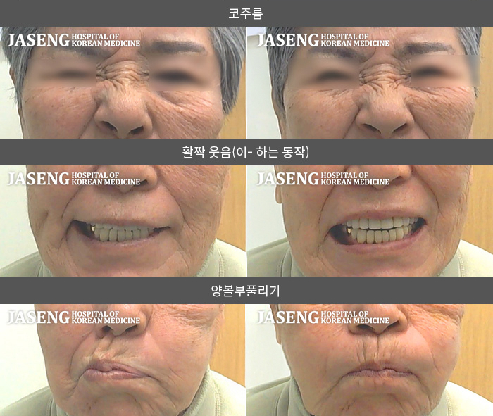 자생한방병원 치료사례 MRI로 보는 치료결과-이유 없이  좌측 안면마비 발생해 1일후 초기부터  내원  본원 양약 처방 및 외래치료 병행 