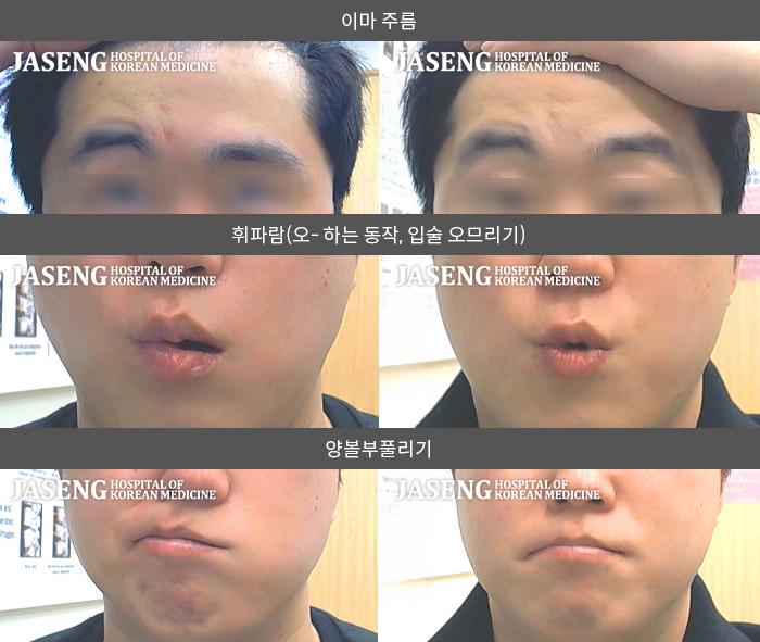 자생한방병원 치료사례 MRI로 보는 치료결과-이유 없이  좌측 안면마비 발생해  타 병원 대상포진에 의한 안면마비 람세이 헌트 증후군 확진 후 내원 