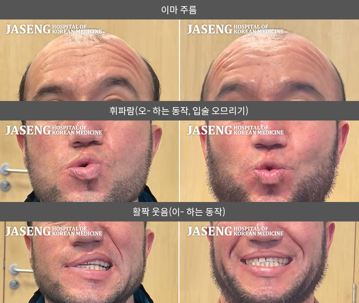 자생한방병원 치료사례 MRI로 보는 치료결과-오른쪽 눈이 잘 안 감기고 오른쪽 안면부 전체 마비된 느낌이다. 