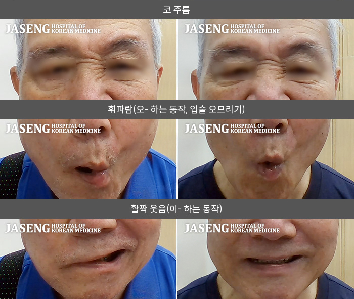 자생한방병원 치료사례 MRI로 보는 치료결과-기상 후 우측안면마비를 인지해 정밀 검사 후 말초성 진단을 받고 내원하였습니다.