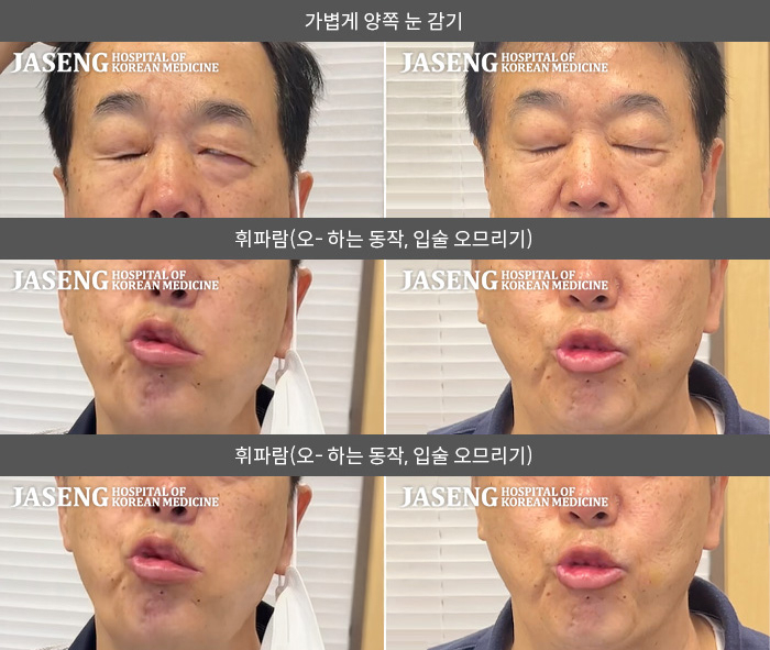 자생한방병원 치료사례 MRI로 보는 치료결과-왼 눈이 잘 안 감기고 왼쪽 안면부 전체 마비된 느낌이다. 