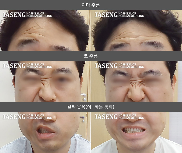 자생한방병원 치료사례 MRI로 보는 치료결과-좌측 안면바미가 발생하여 좌측 이마 주름잡기와 눈 감고 뜨기가 불편하였습니다.