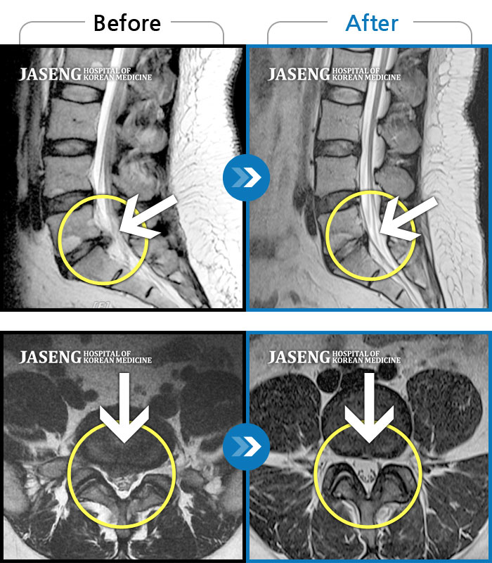 자생한방병원 치료사례 MRI로 보는 치료결과-허리 골반으로 움직일때 통증이 있고 다리 저림