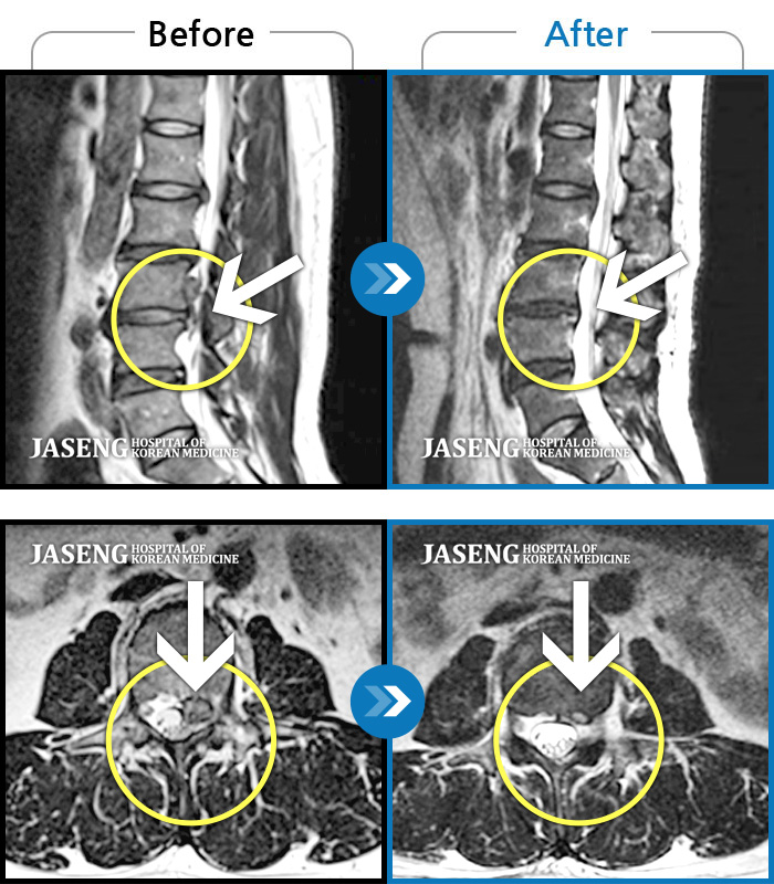 자생한방병원 치료사례 MRI로 보는 치료결과-허리 골반 통증과 다리 당기고 저리는 통증, 걷을 때 통증, 야간통