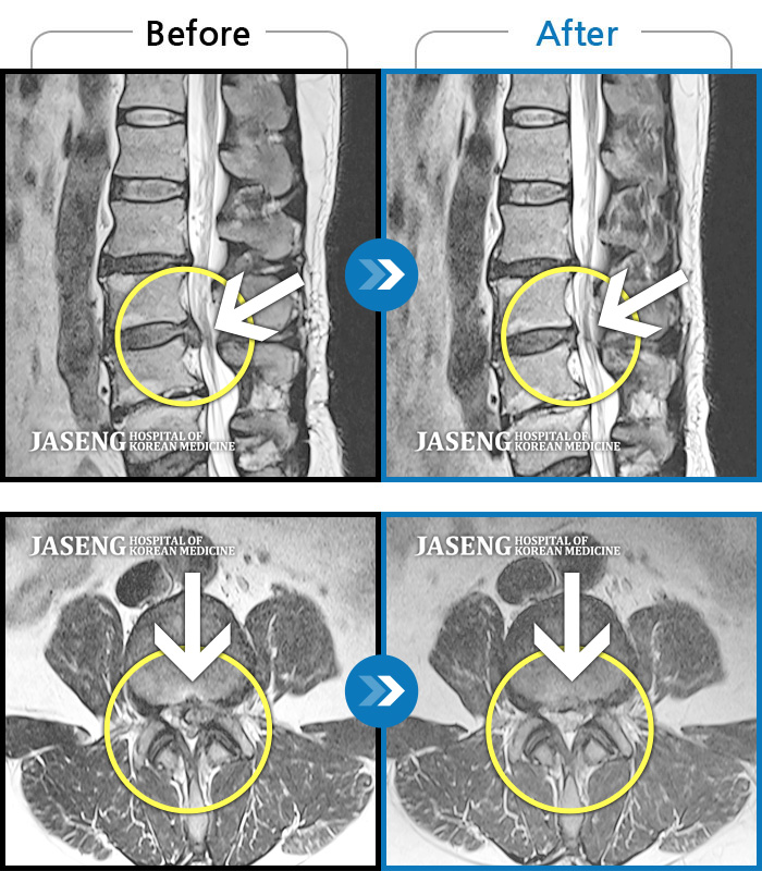 자생한방병원 치료사례 MRI로 보는 치료결과-좌측 하부요추부터 골반통증 및 양측 하지 방사통