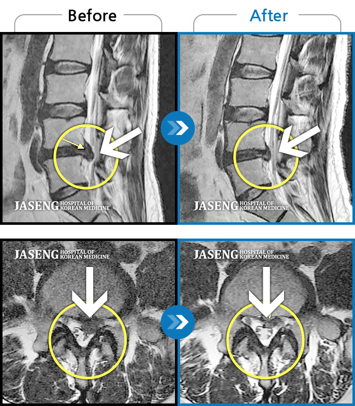 자생한방병원 치료사례 MRI로 보는 치료결과-허리를 굽히거나 걸을때 양쪽다리 통증