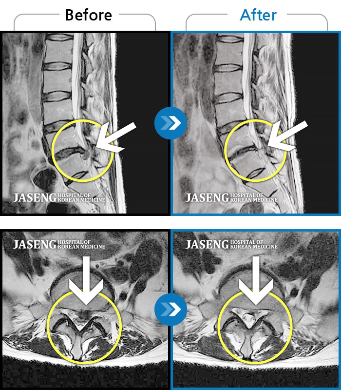 자생한방병원 치료사례 MRI로 보는 치료결과-허리,엉치 통증 있고 왼쪽 종아리, 발가락쪽으로 저림