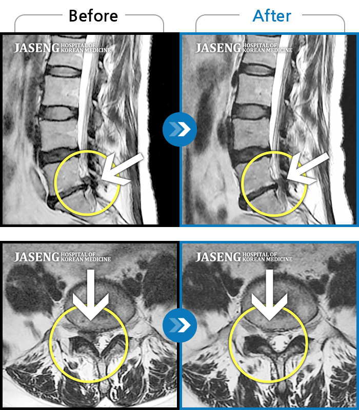 자생한방병원 치료사례 MRI로 보는 치료결과-우측 허리 엉덩이부터 다리 당김, 통증
