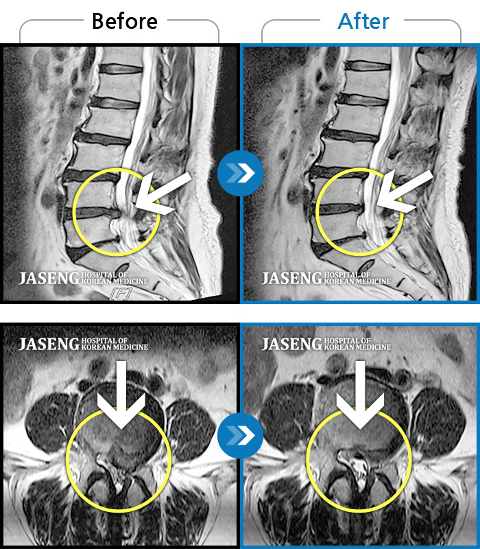 자생한방병원 치료사례 MRI로 보는 치료결과-허리 골반 통증, 왼쪽 허벅지부터 발등까지 저리고 당김