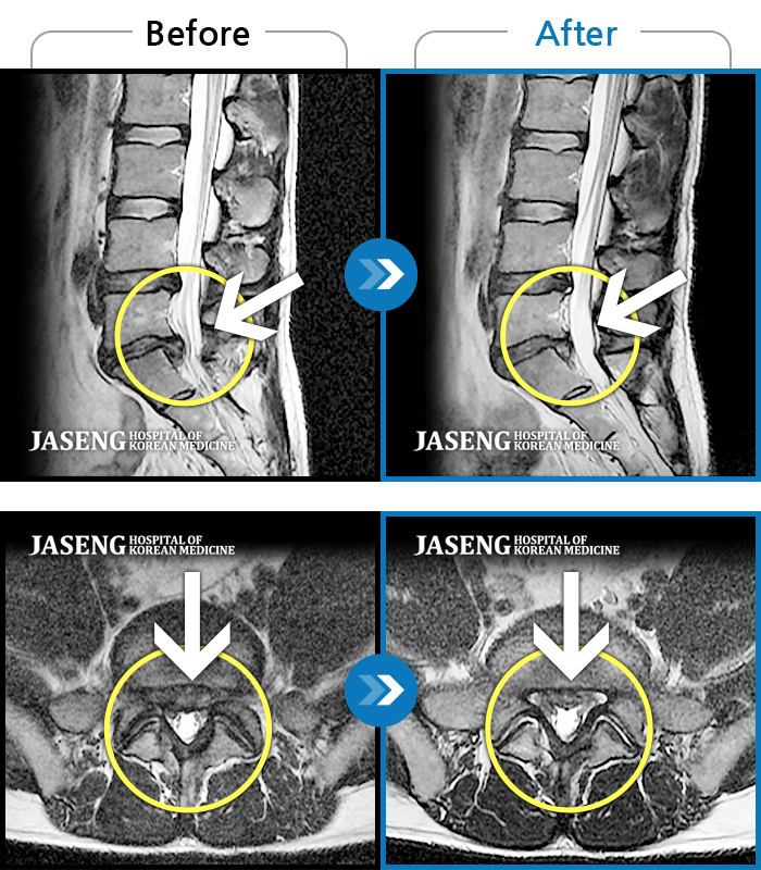 자생한방병원 치료사례 MRI로 보는 치료결과-허리통증으로 보행 불가 및 거동 불가, 좌측 둔부 통증