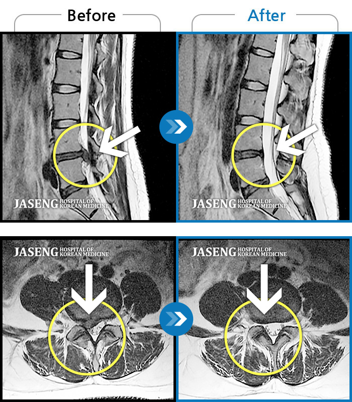 자생한방병원 치료사례 MRI로 보는 치료결과-허리 골반 통증, 우측 다리가 뒤로 당김