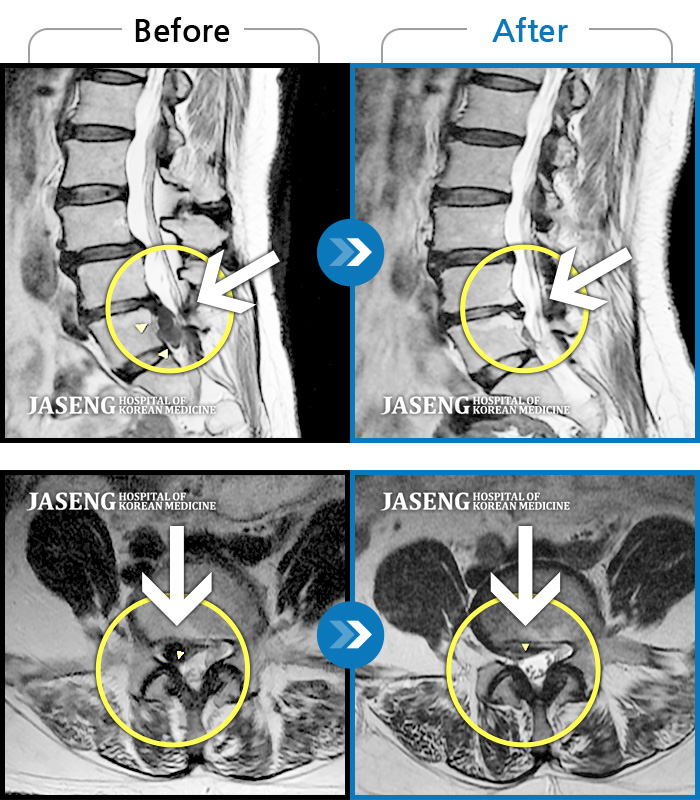 자생한방병원 치료사례 MRI로 보는 치료결과-허리 골반통증 및 우 하지 방산통