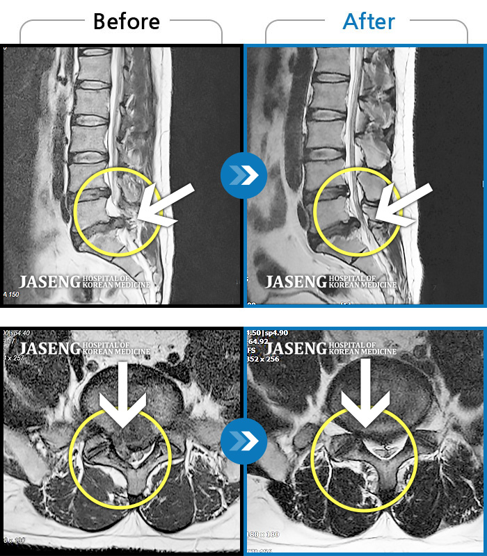 자생한방병원 치료사례 MRI로 보는 치료결과-디스크 파열 후 허리 골반 통증, 허리 숙일 때 다리 당김 증상