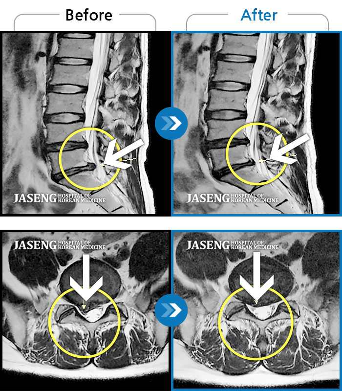 자생한방병원 치료사례 MRI로 보는 치료결과-요통과 우측 하지부 당김 증상