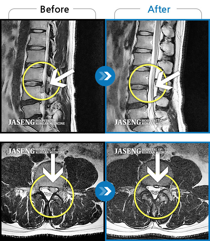 자생한방병원 치료사례 MRI로 보는 치료결과-좌측 하지 방사통, 보행 불가, 하지 근력 저하