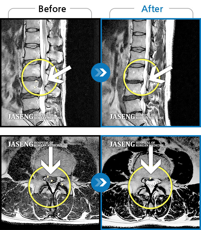 자생한방병원 치료사례 MRI로 보는 치료결과-허리디스크로 인한 요통