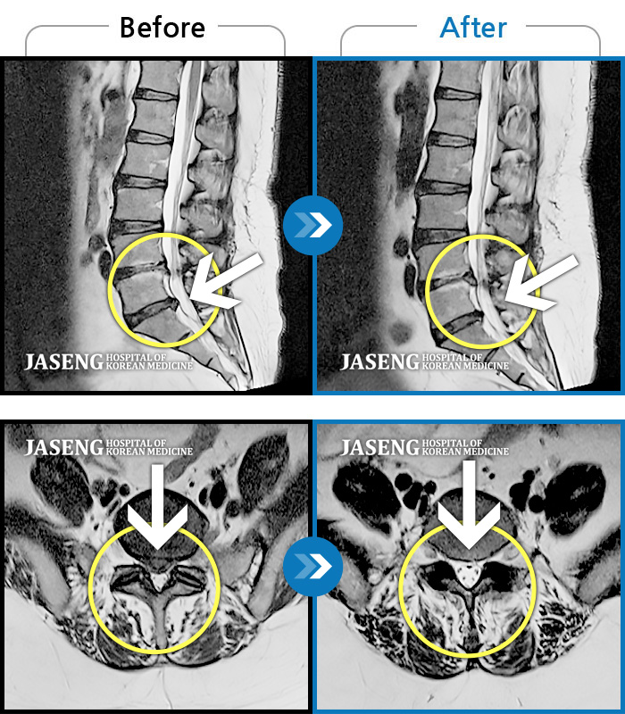 자생한방병원 치료사례 MRI로 보는 치료결과-허리 골반 통증, 왼쪽 허벅지에서 종아리 발까지 당김 증세 및 통증