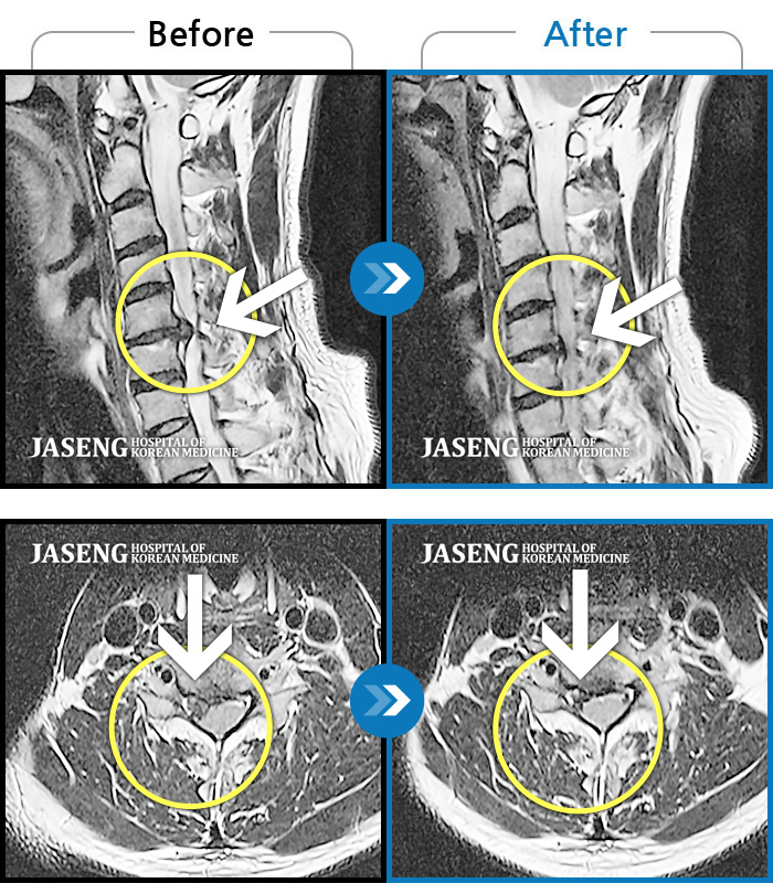 자생한방병원 치료사례 MRI로 보는 치료결과-목 통증과 우측 팔로 당기는 통증, 야간통
