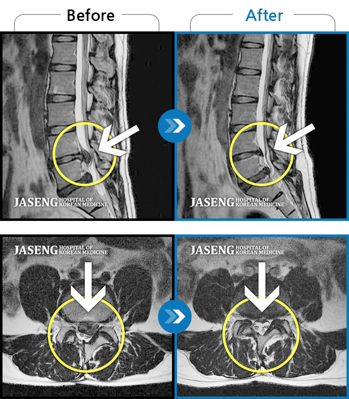 자생한방병원 치료사례 MRI로 보는 치료결과-왼쪽 허리 통증 및 왼쪽 하지의 저림, 감각이상, 족하수